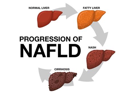 Pediatric Nonalcoholic Fatty Liver Disease Nafld Best Practices For