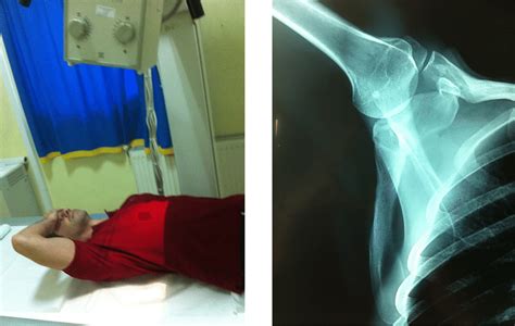 Suprascapular Notch Xray