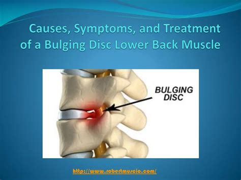 PPT - Causes, Symptoms, and Treatment of a Bulging Disc Lower Back ...