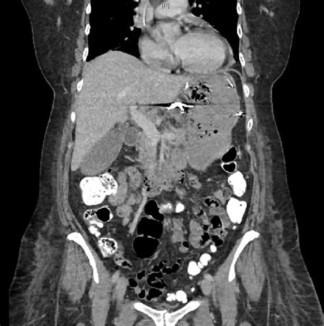 Gastric Necrosis And Perforation Following Treatment Of Dieulafoy’s Lesion With Embolization Of