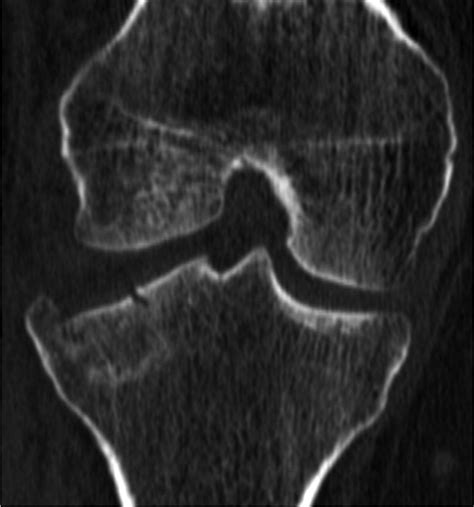 Schatzker Classification Of Tibial Plateau Fractures Use Of Ct And Mr