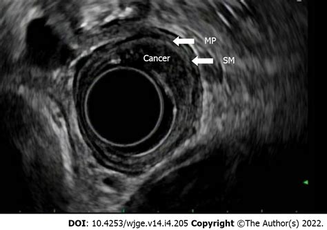 Gastroesophageal Junction Ultrasound