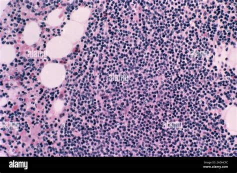 Leukaemia Light Micrograph Of A Section Through Bone Marrow Tissue From A Patient With Chronic