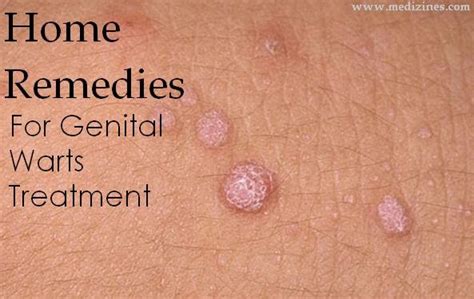 Genitle Warts Treatment Pictures Photos