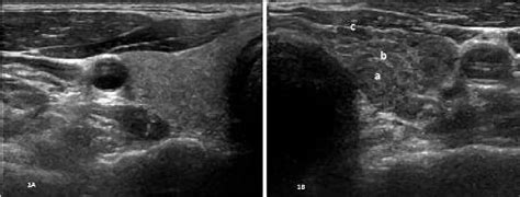 Figure 1 From The Increased Risk Of Globus Pharyngeus In Patients With