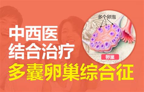 多囊卵巢综合症的症状原因 治疗多囊卵巢怀孕医院 多囊卵巢手术多少钱 广州仁爱医院 广州仁爱天河医院不孕不育科