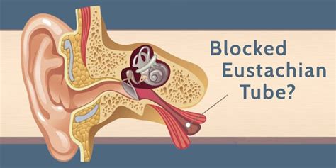 What a blocked Eustachian Tube means - Wax Removal NI