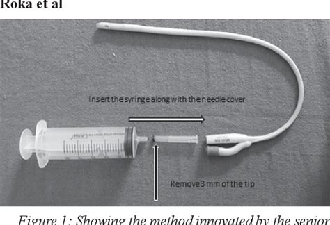 Figure 1 from Single Burr Hole and Drainage in Chronic Subdural ...