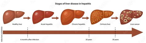 Stages Of Liver Disease In Hepatitis With Description Corresponding