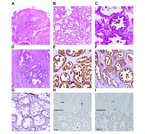 Histopathologic Examination And Molecular Pathologic Results Of