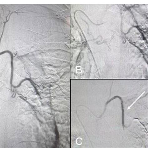 A Digital Subtraction Angiography DSA Image In Arterial Phase Showing