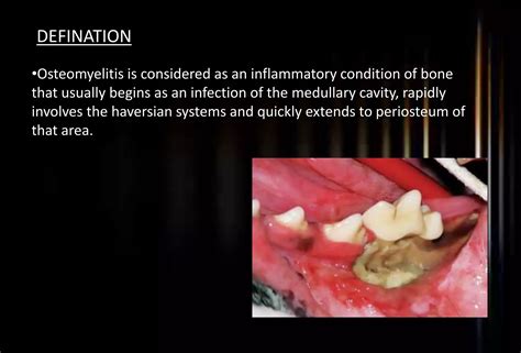 Osteomyelitis And Osteoradionecrosis Of Jaws PPT