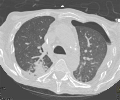 Bilateral Pneumothorax Chest Case Studies Ctisus Ct Scanning