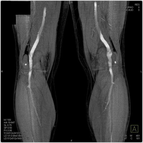 Popliteal Aneurysm