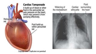 Complications of cardiac surgery