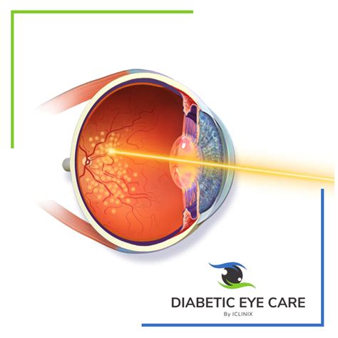 Retina Laser Treatment – Diabetes Eye Care