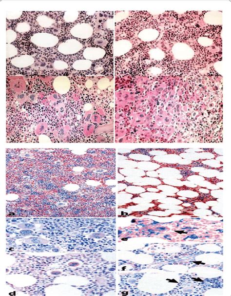 Et Left Upper Et Pv Left Right And Pv Left Bottum Bone Marrow