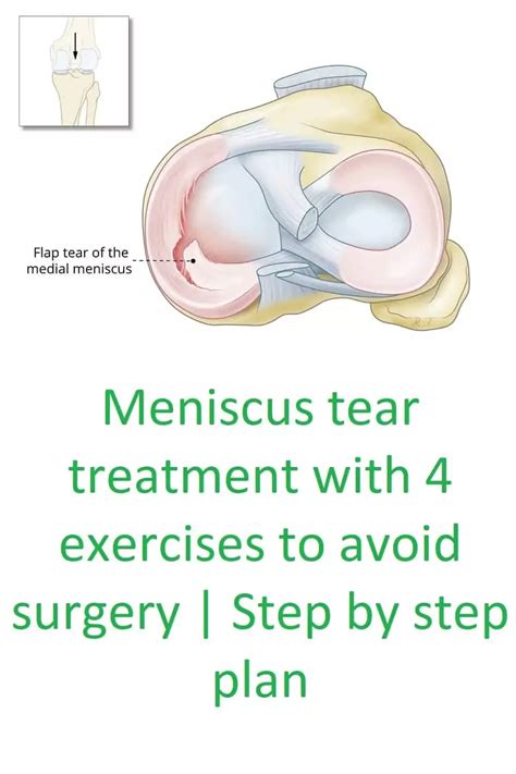 Meniscus tear cause symptoms and treatment with exercises – Artofit