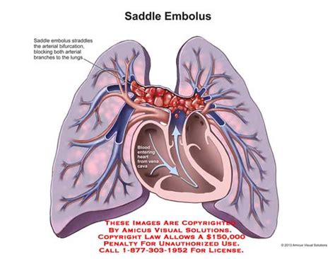 Amicus Illustration Of Amicusanatomylungheartarteryarteriessaddleembolusbifurcation