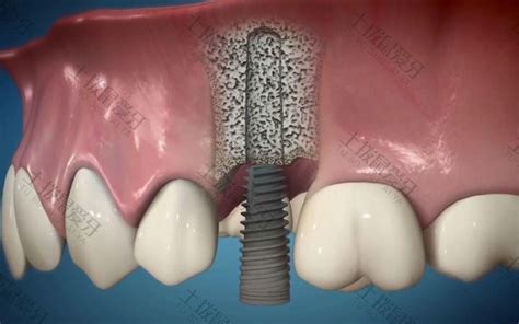 拔牙后种植牙还是镶牙好些 镶牙好还是种植牙好该如何选择 土拨鼠爱牙