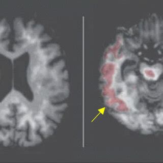 PET scan of the normal individual (left) and Alzheimer’s patient ...