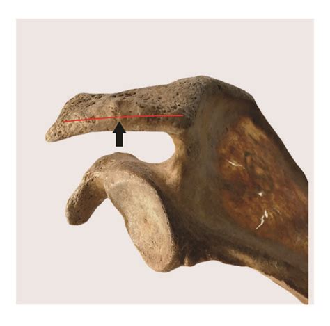 Three Types Of Acromions According To Bigliani Et Al 1986 A Flat