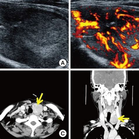 Ultrasonographic Findings Of A Parathyroid Adenoma At A Local Hospital