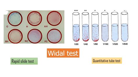 Widal test: Introduction, procedure, result Interpretation and limitations