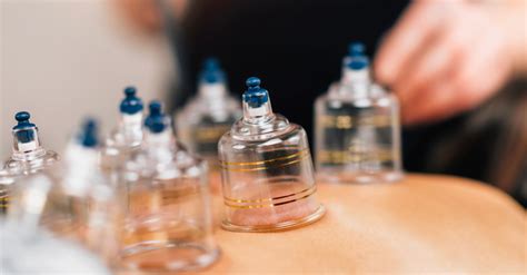 Things You Should Know About Cupping Therapy