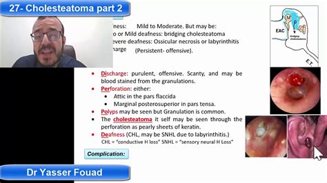 27 Cholesteatoma Part 2 Youtube