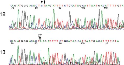 DNA Sequencing Chromatogram Illustrates The Mutation 185delAG