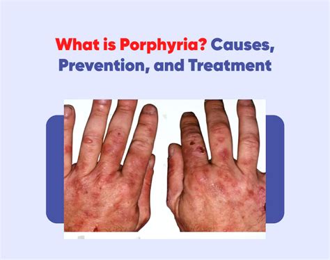 What is Porphyria? Causes, Prevention & Treatment