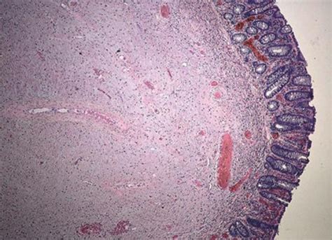 Histological Features Of Colonic Neurofibroma Low Power View Of