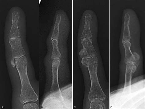 Plain A Anteroposterior And B Lateral Radiographs Taken At A