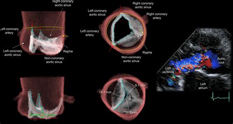 Understanding The Aortic Root Using Computed Tomographic Assessment A