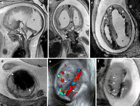 Fetal MRI and US in a second case of dysplastic megalencephaly... | Download Scientific Diagram