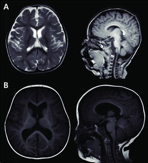 Microcephaly and megalencephaly. (A) Brain MRI of an 18-monthold male ...