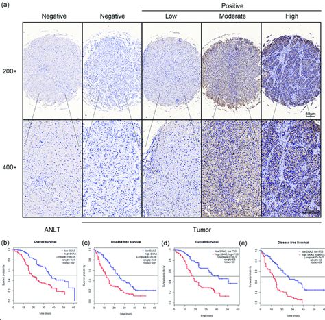 Ska3 Expression Is Correlated With Clinicopathological Features And