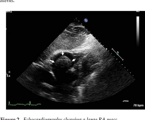 Figure From Intravenous Leiomyomatosis With Intracardiac Extension