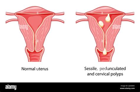 Set Of Polyps In The Uterus Female Reproductive System In Cross