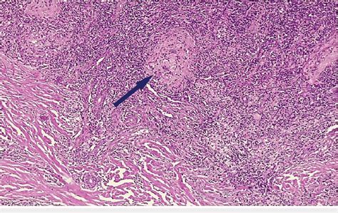 Histology Section Showing Dense Chronic Inflammatory Infiltrate Giant Download Scientific