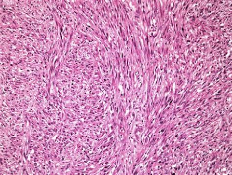 Sarcomatoid Carcinoma With Fascicles Of Malignant Spindle Cells