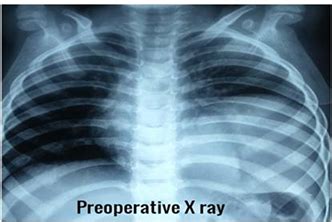 Pleuropulmonary Blastoma In Pediatric Age Group A Very Rare Case