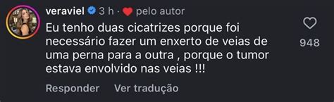 Vera Viel explica cicatrizes após retirada de tumor Enxerto de veias