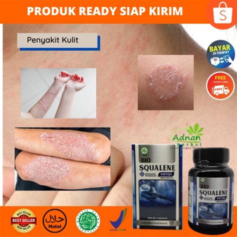 Jual Bio Squalene Softgel Obat Alergi Kulit Eksim Gatal Gatal