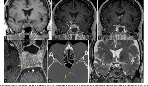 Figure From A Case Of Nonapoplectic Pituitary Adenoma Presenting With