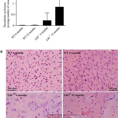 A) Thrombotic occlusions (referred to as suspected fibrin thrombi) of ...