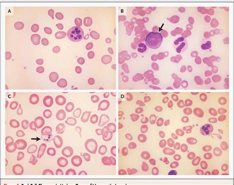 Hemoglobin Sc Disease Blood Smear