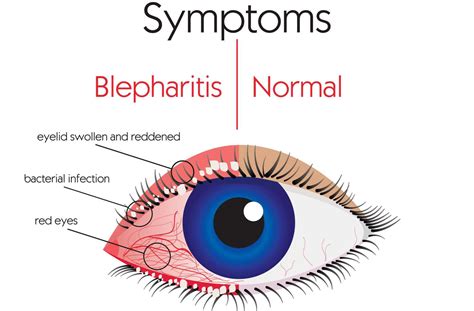 Keeping Eyelids Healthy The Importance Of Eyelid Hygiene