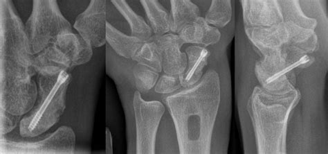 Scaphoid Fracture Treatment Surgery